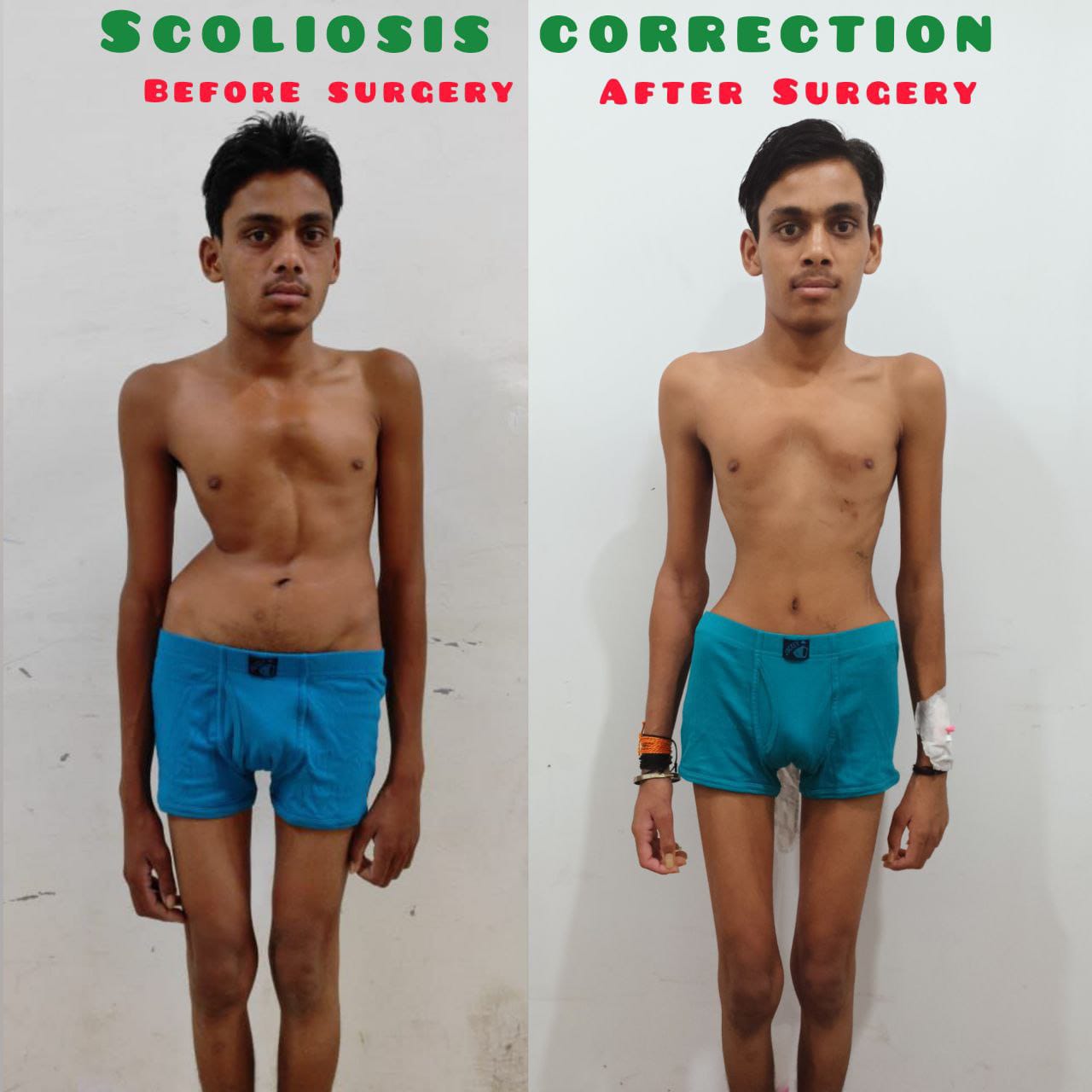 Management Of Scoliosis & Other Spine Deformities